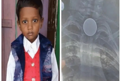 Death by swallowing a coin