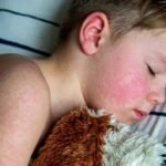 Deadly measles virus found in California sewer