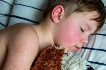 Deadly measles virus found in California sewer