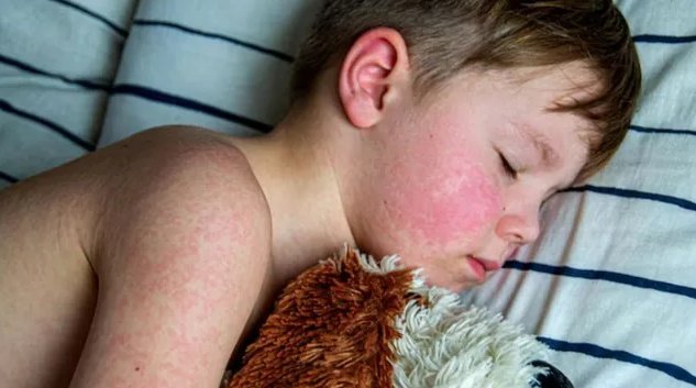 Deadly measles virus found in California sewer